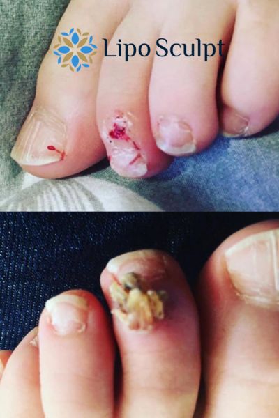 Wart removal customer results from Lipo Sculpt Lytham St Annes